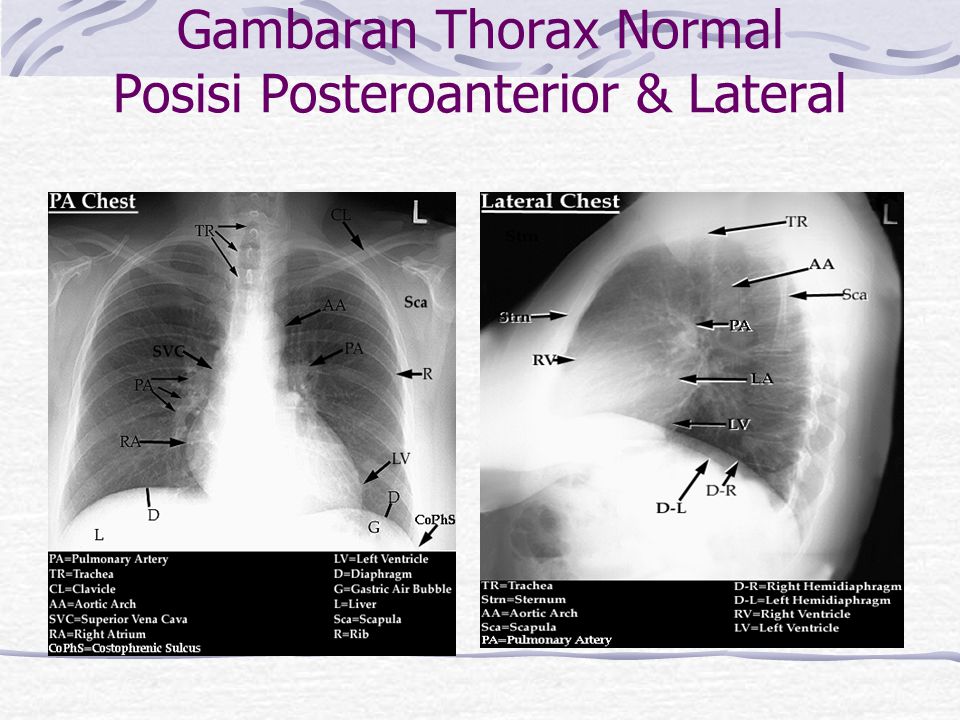 Radiologi Thorax Abdomen Normal Ppt Download Gambaran Posisi Posteroanterior Lateral