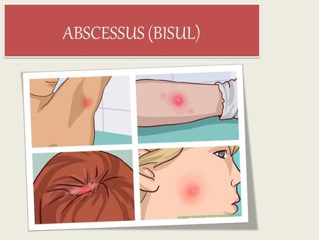 ABSCESSUS (BISUL). PENGERTIAN Bisul adalah benjolan merah pada kulit yang terasa sakit dan berisi nanah. Benjolan ini muncul akibat infeksi bakteri yang.