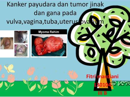 Kanker payudara dan tumor jinak dan gana pada vulva,vagina,tuba,uterus,ovarium Fitri mardiani 130104 III B.