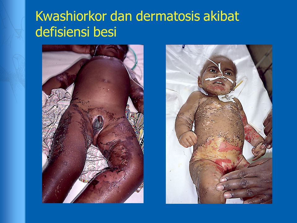Kwashiorkor dan dermatosis akibat defisiensi besi