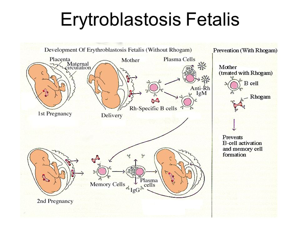 Erytroblastosis Fetalis