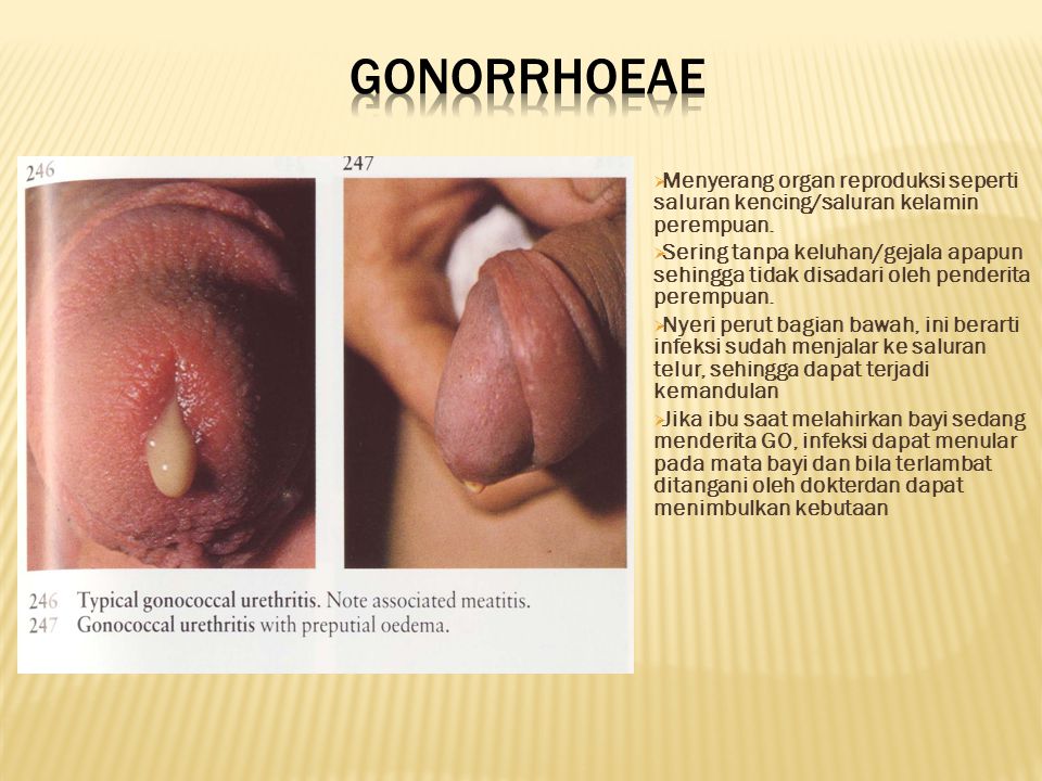 Gonorrhoeae Menyerang organ reproduksi seperti saluran kencing/saluran kelamin perempuan.