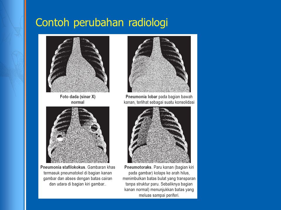 Contoh perubahan radiologi