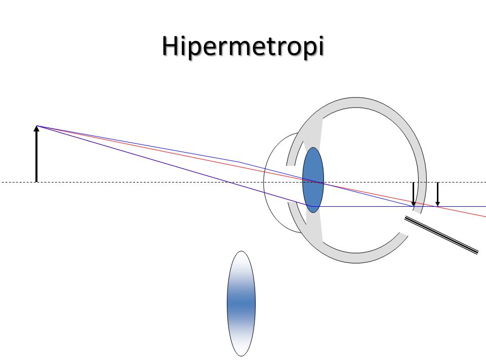 Hipermetropi