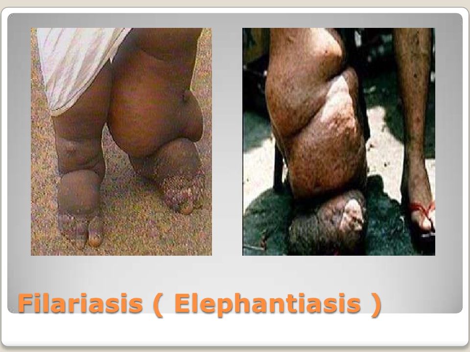 FILARIASIS Filariasis (penyakit kaki gajah) : penyakit kronis yang ditularkan melalui gigitan nyamuk.