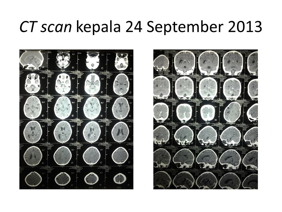 CT scan kepala 24 September 2013