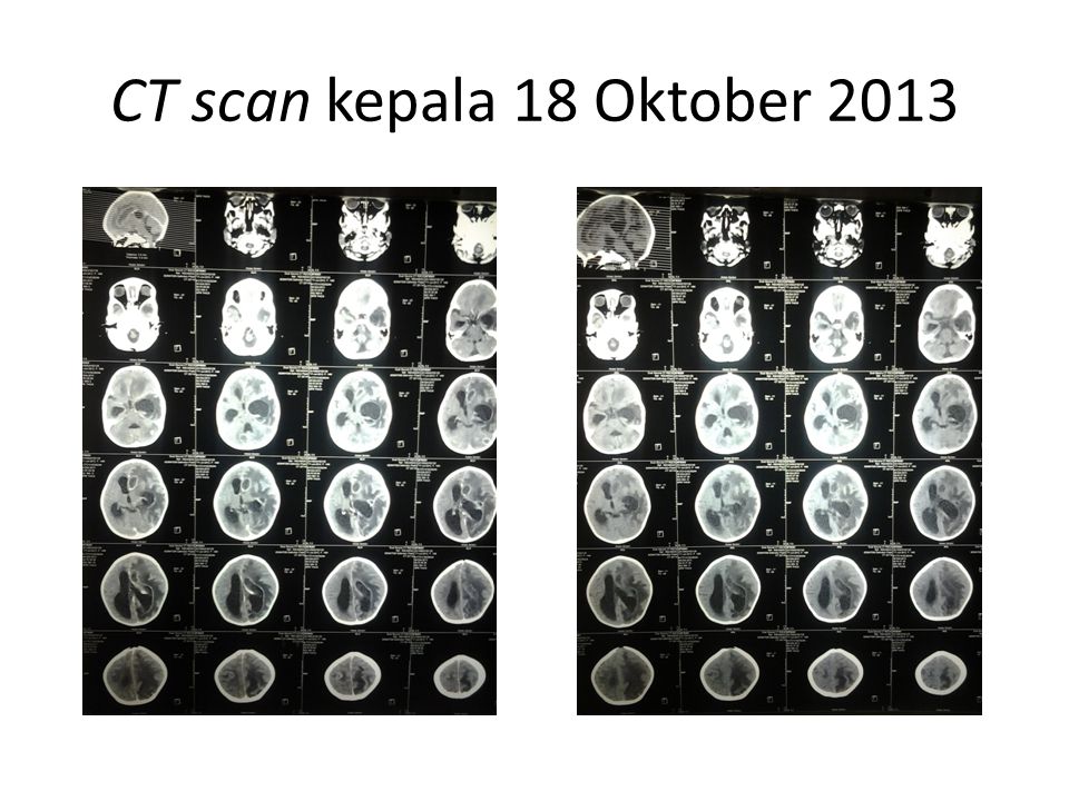 CT scan kepala 18 Oktober 2013