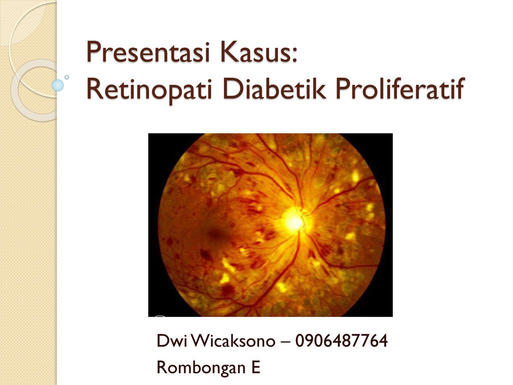 A diabetes mellitus retinopátia története