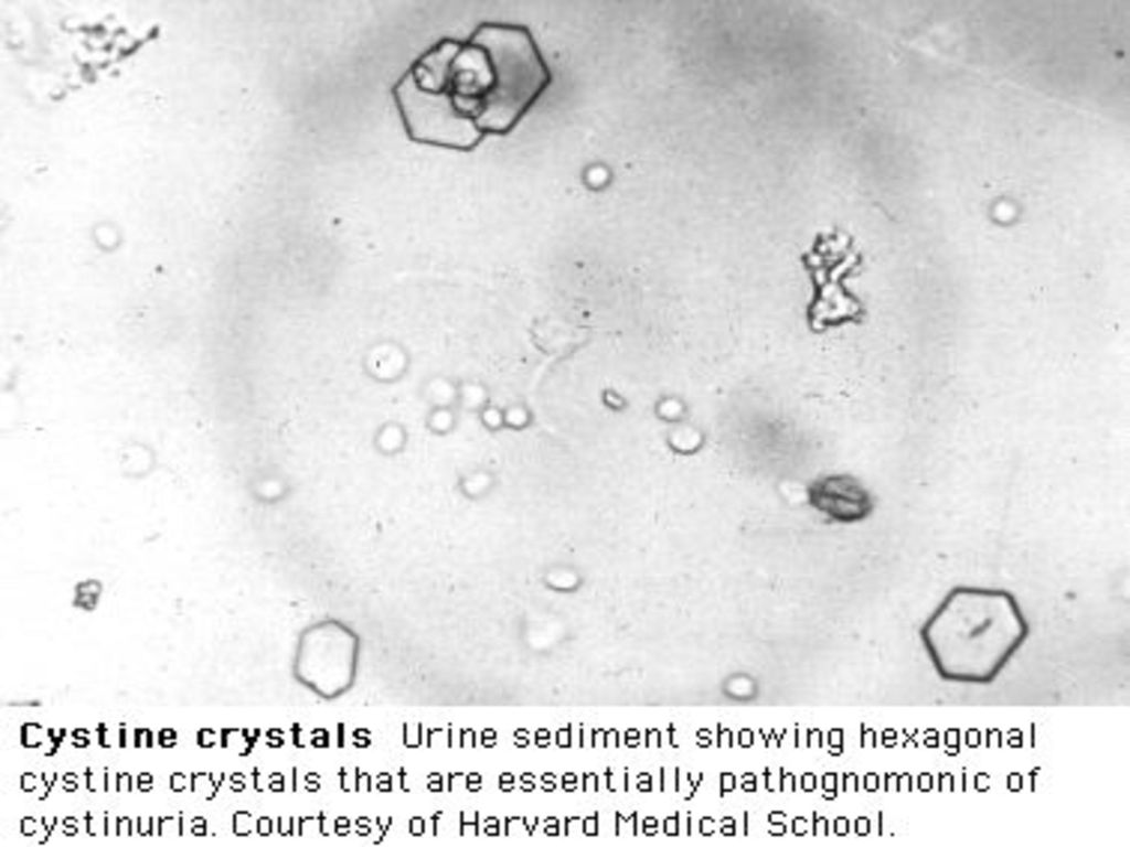 Кристаллы оксалата в моче у мужчин. Цистин в моче микроскопия. Цистин Кристаллы в моче. Кристаллы цистина микроскопия. Кристаллы цистина в моче микроскопия.