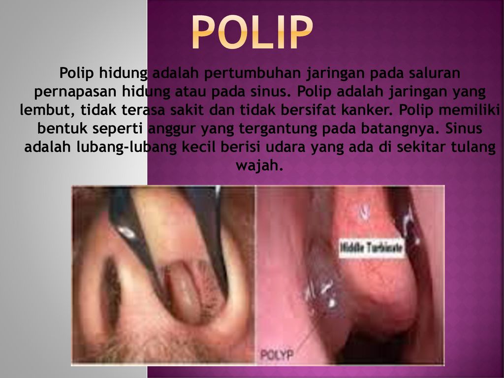 Polip Polip Hidung Adalah Pertumbuhan Jaringan Pada Saluran Pernapasan Hidung Atau Pada Sinus Polip Adalah Jaringan Yang Lembut Tidak Terasa Sakit Ppt Download