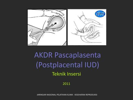 AKDR Pascaplasenta (Postplacental IUD)