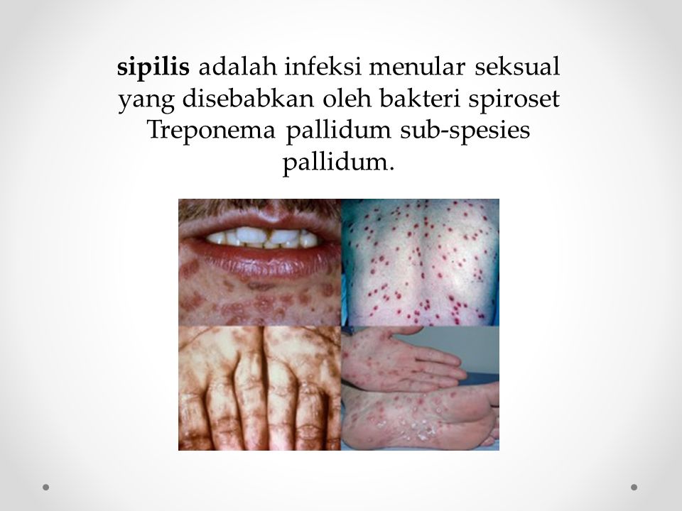 sipilis adalah infeksi menular seksual yang disebabkan oleh bakteri spiroset Treponema pallidum sub-spesies pallidum.