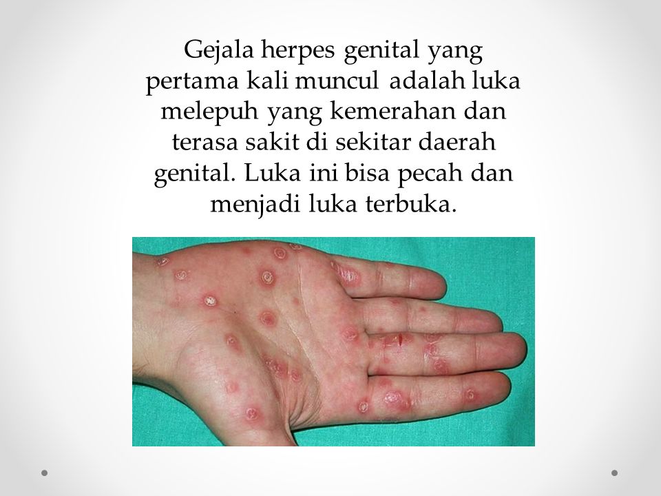 Gejala herpes genital yang pertama kali muncul adalah luka melepuh yang kemerahan dan terasa sakit di sekitar daerah genital.