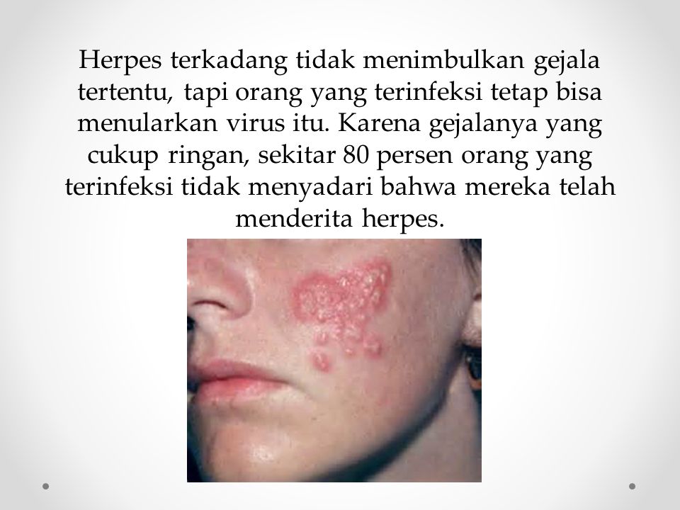 Herpes terkadang tidak menimbulkan gejala tertentu, tapi orang yang terinfeksi tetap bisa menularkan virus itu.