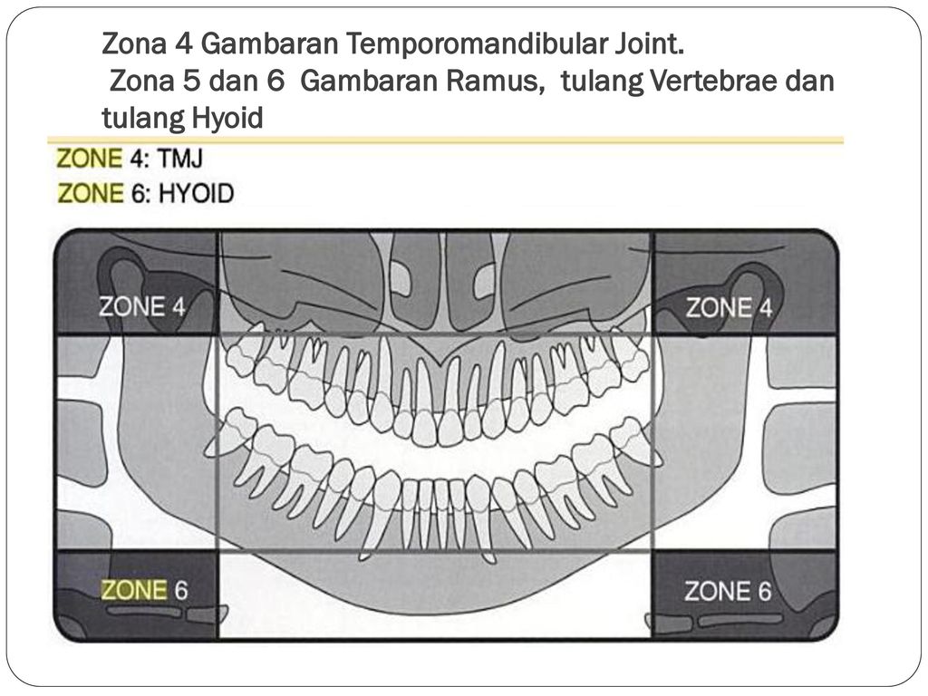Zona 4 Gambaran Temporomandibular Joint