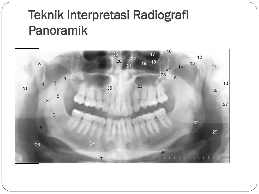 Teknik Interpretasi Radiografi Panoramik
