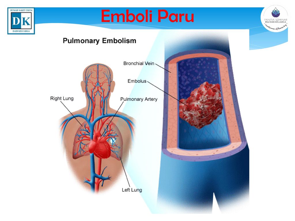 Эмболия тромбы. Воздушная эмболия легочной артерии.