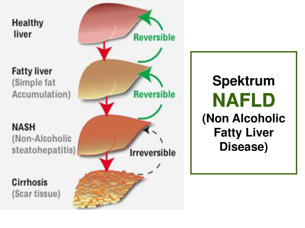Spektrum NAFLD (Non Alcoholic Fatty Liver Disease)