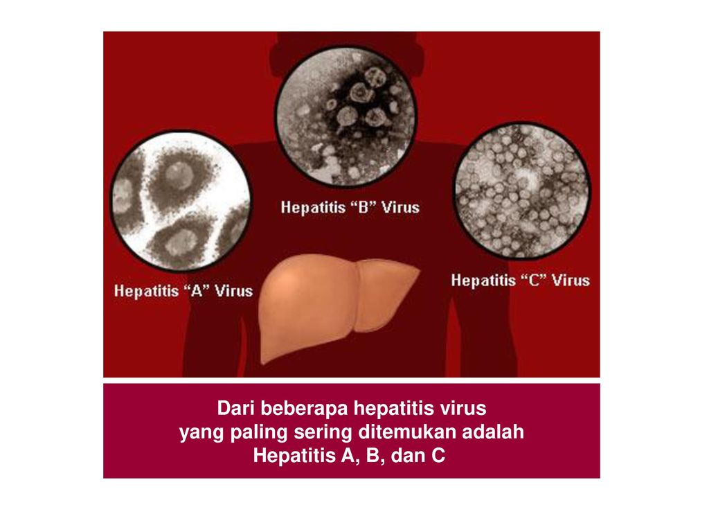 Dari beberapa hepatitis virus yang paling sering ditemukan adalah