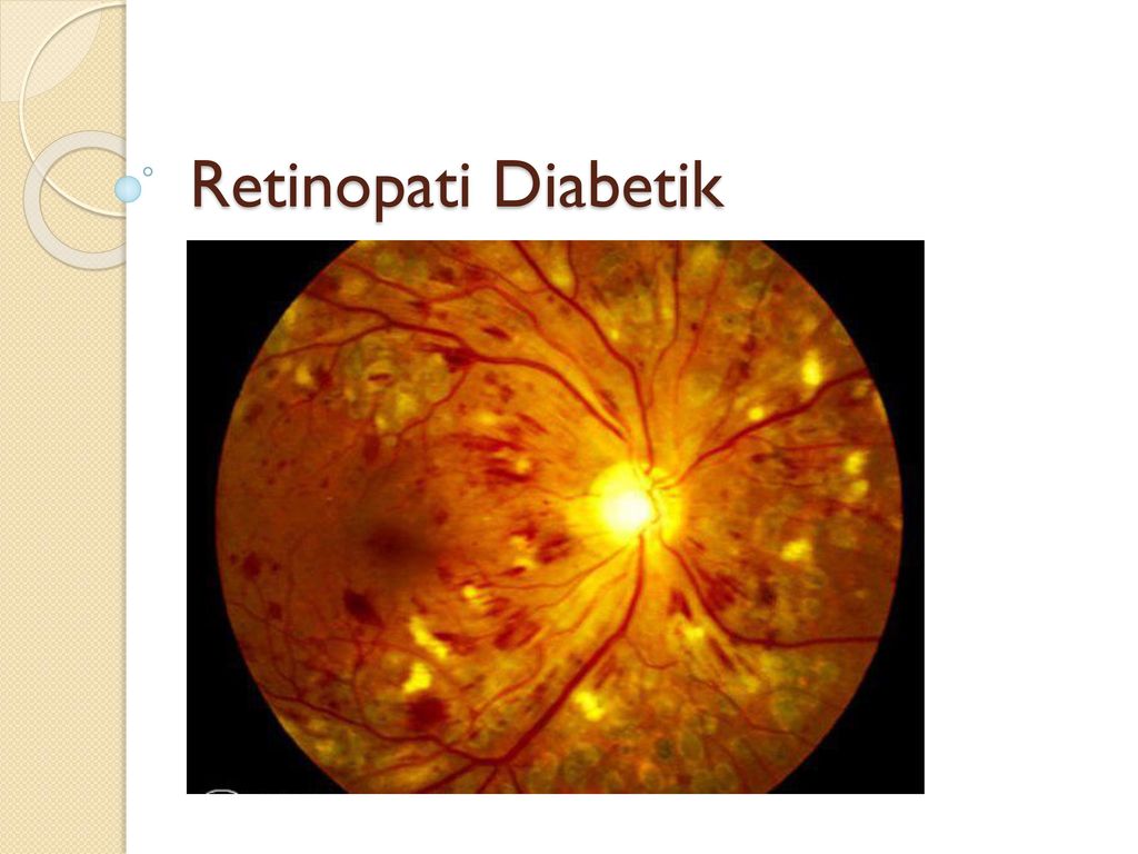 retinopatia diabetica proliferativa fisiopatologia)