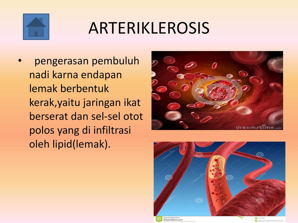 ARTERIKLEROSIS