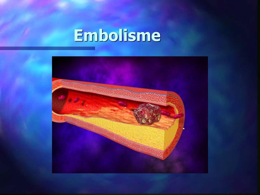 Embolisme