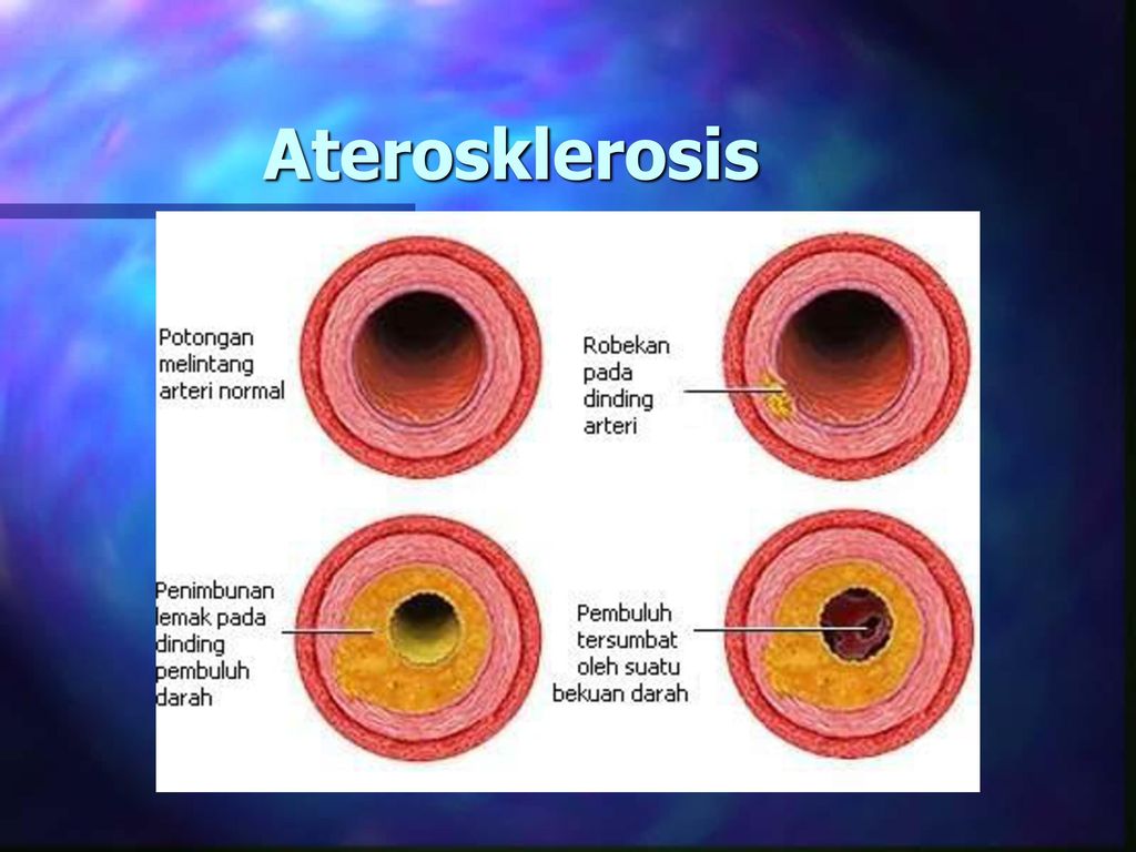 Aterosklerosis