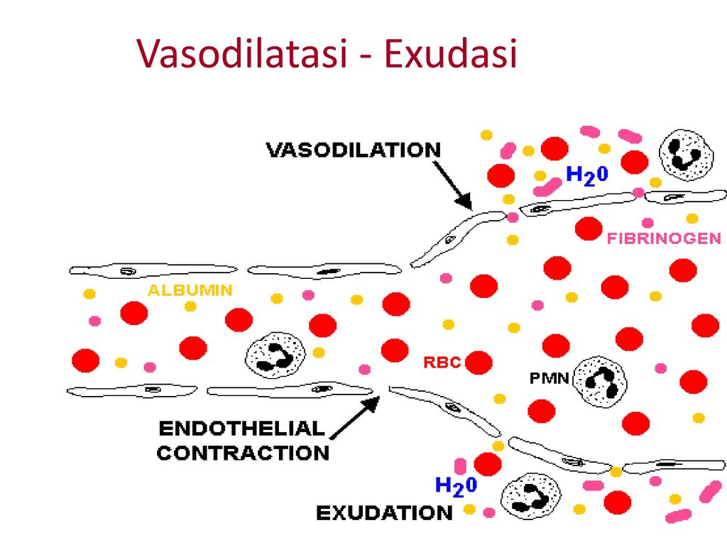 Vasodilatasi - Exudasi