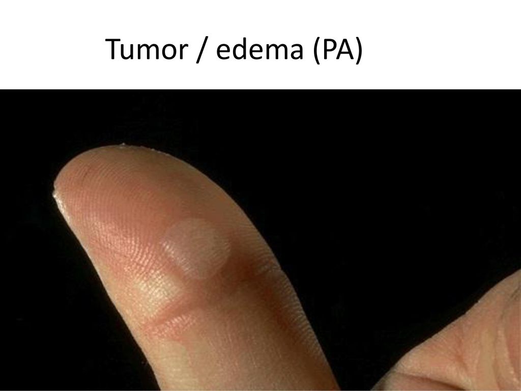 Tumor / edema (PA)
