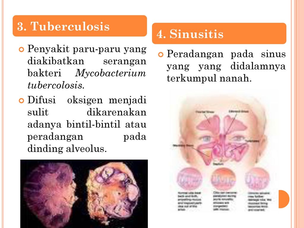 3. Tuberculosis 4. Sinusitis