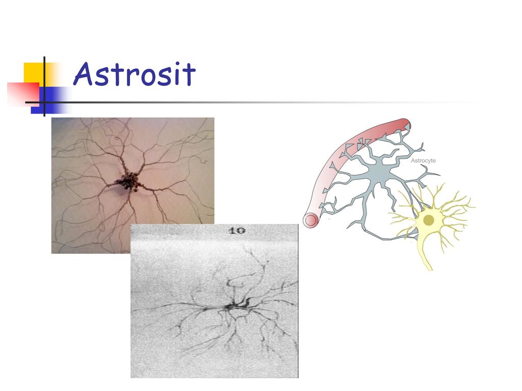 Астроцит клиника. Глиальные клетки астроциты. Астроциты головного мозга. Глиальная реакция. Глия головного мозга.
