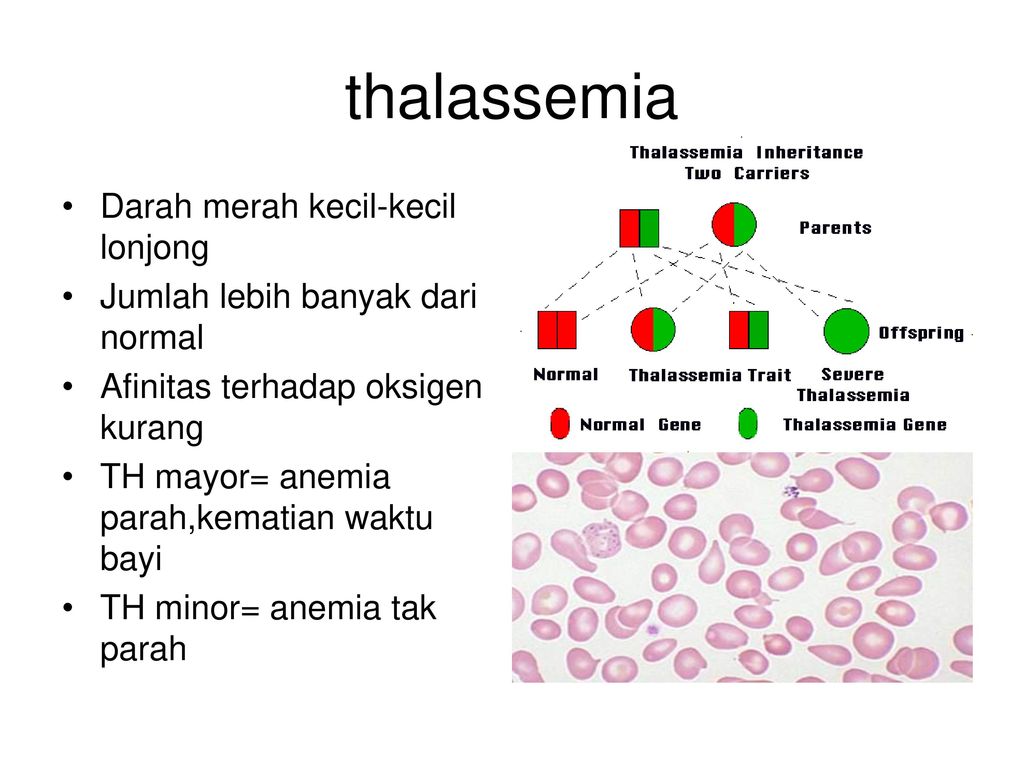 Талассемия что это. Талассемия. Талассемия патогенез. Талассемия классификация. Бета талассемия минор это.