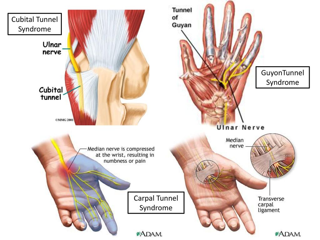 Carpal Tunnel Syndrome. 
