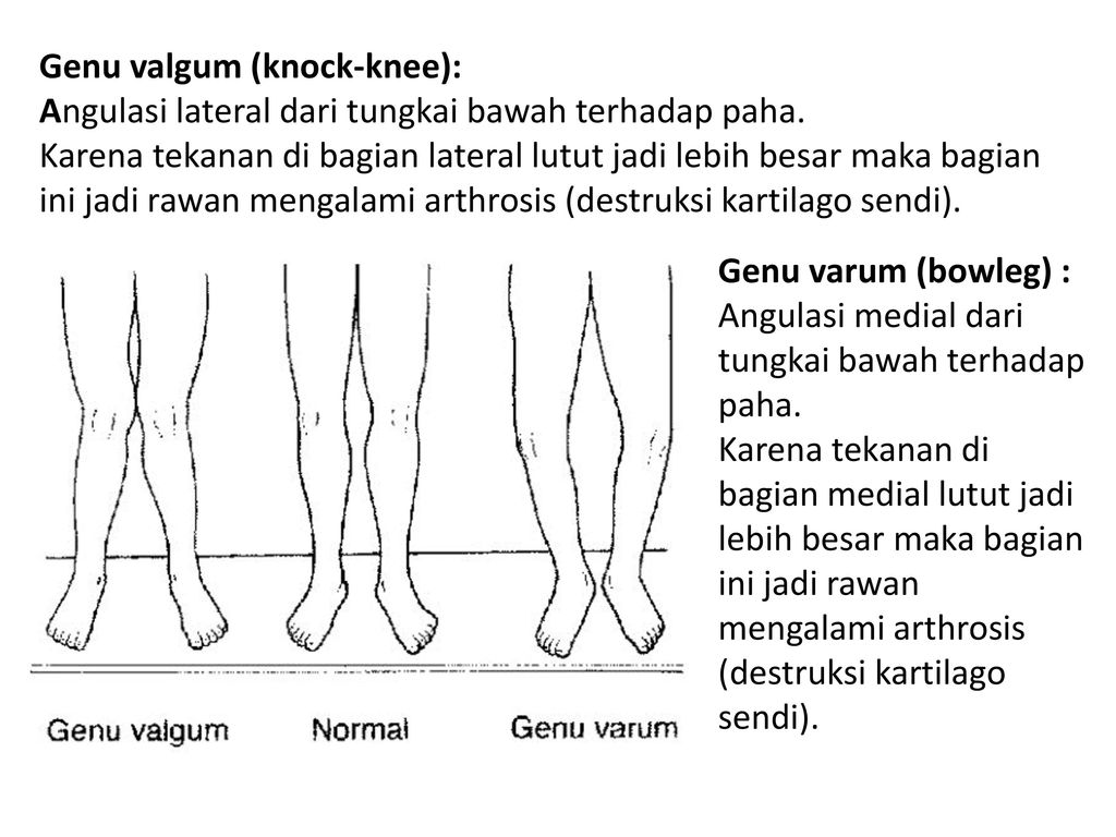 Genu valgum (knock-knee) .