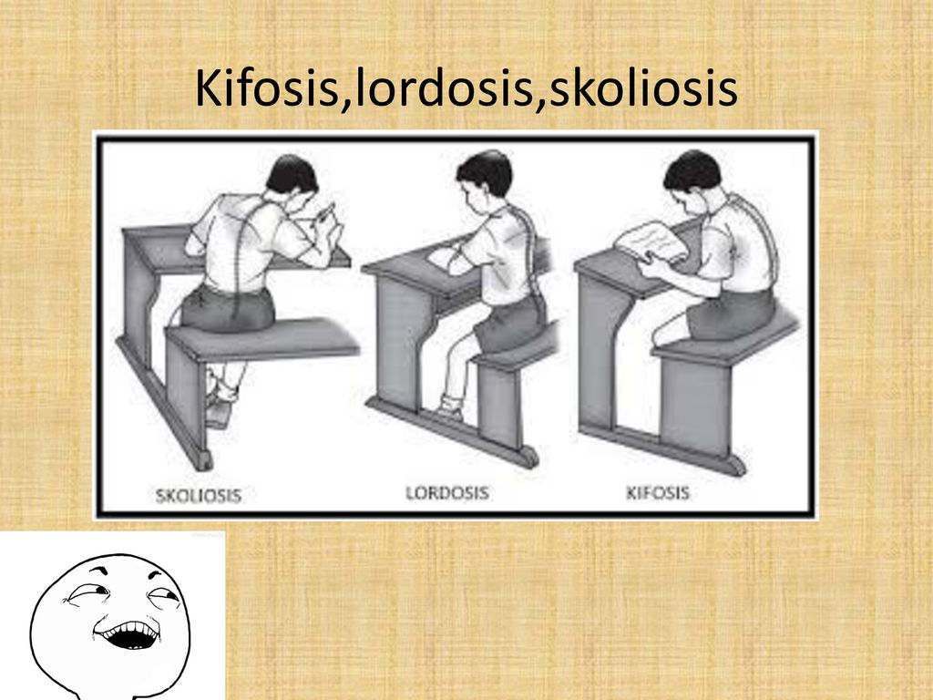 Lordosis kifosis dan skoliosis adalah kelainan tulang yang disebabkan oleh