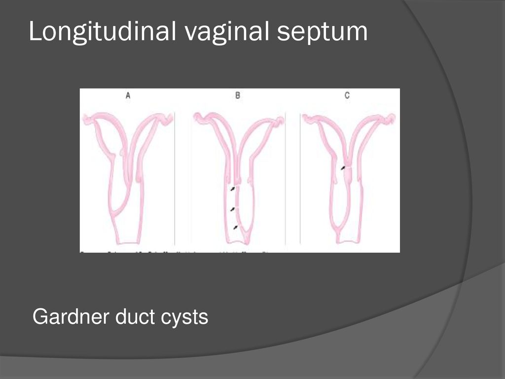 Uterus Didelphys Porn