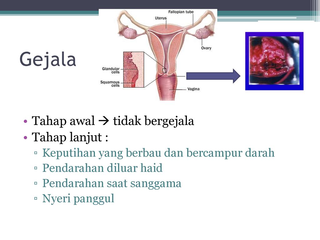 Deteksi Dini Kanker Leher Rahim Iva Tes Ppt Download