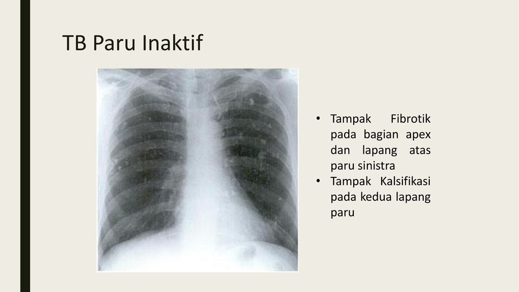 TB Paru Inaktif Tampak Fibrotik pada bagian apex dan lapang atas paru sinistra.