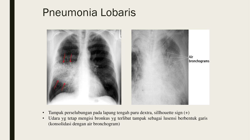 Pneumonia Lobaris Tampak perselubungan pada lapang tengah paru dextra, sillhouette sign (+)