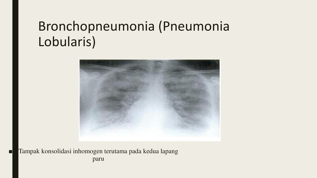 Bronchopneumonia (Pneumonia Lobularis)