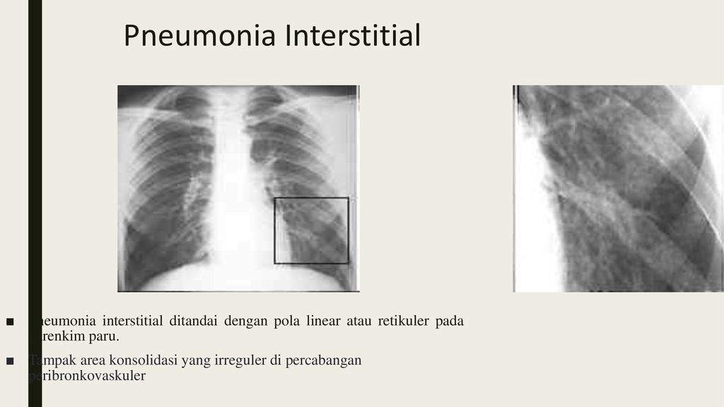 Pneumonia Interstitial