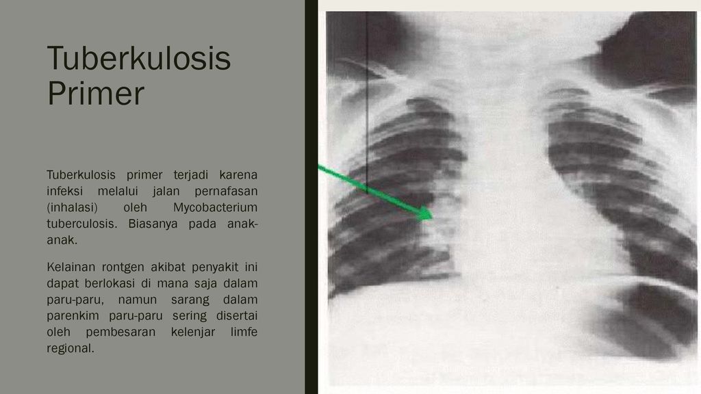 Tuberkulosis Primer