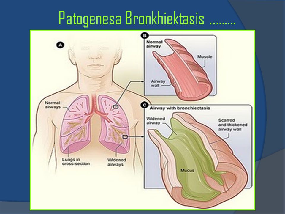 Patogenesa Bronkhiektasis