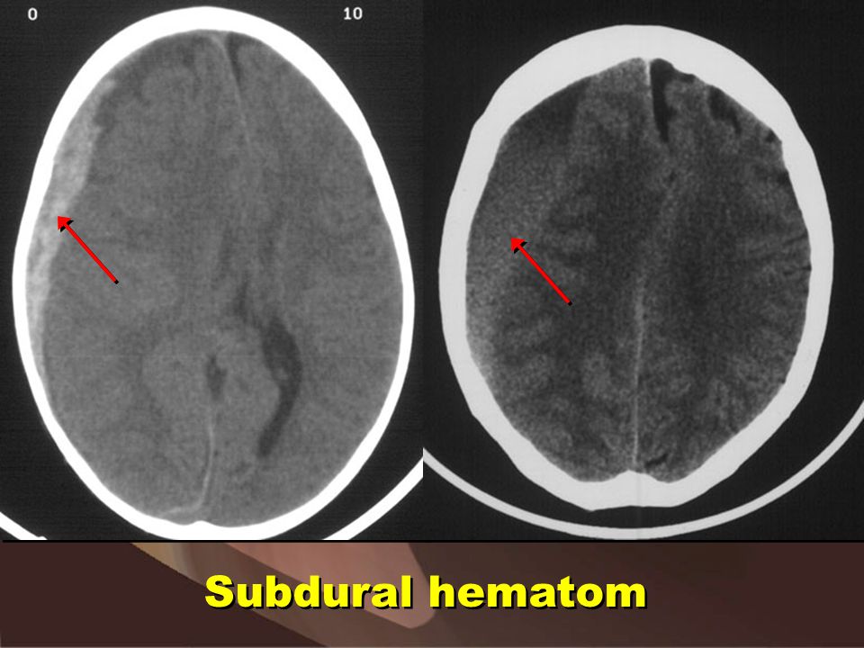 Hominick Hematoma