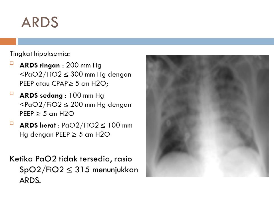 ARDS Tingkat hipoksemia: ARDS ringan : 200 mm Hg <PaO2/FiO2 ≤ 300 mm Hg dengan PEEP atau CPAP≥ 5 cm H2O;