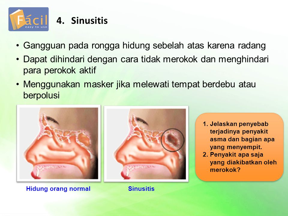 4. Sinusitis Gangguan pada rongga hidung sebelah atas karena radang