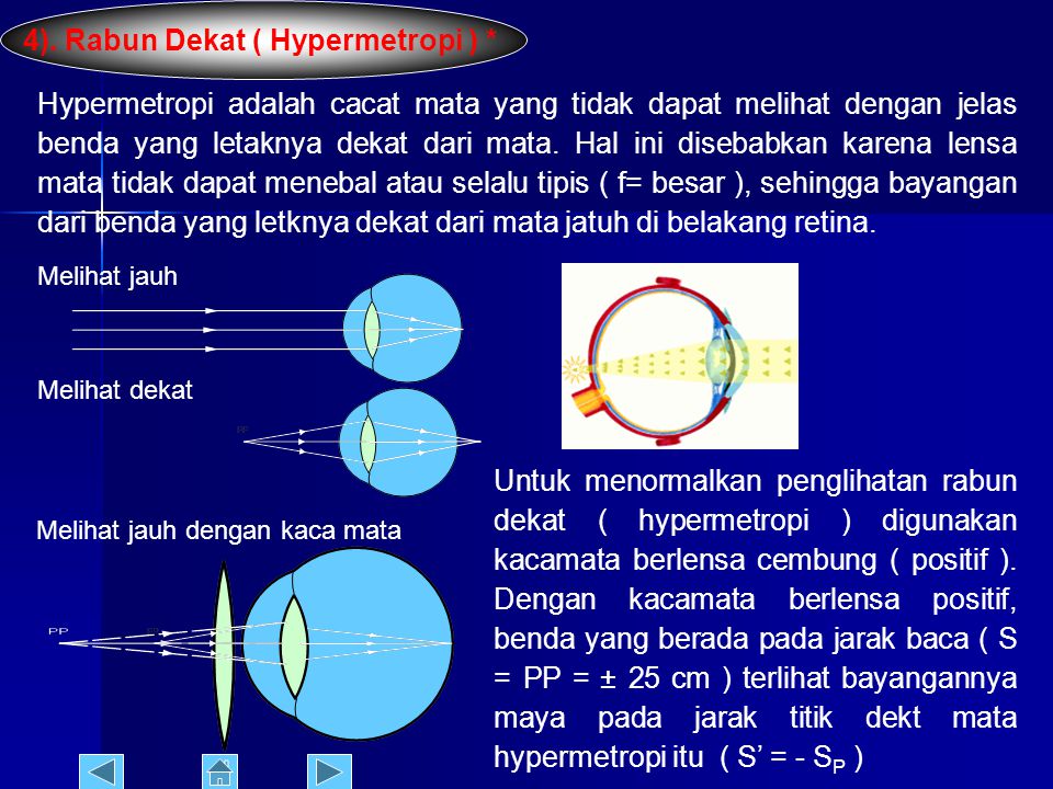 4). Rabun Dekat ( Hypermetropi ) *