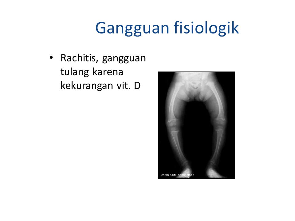 Gangguan fisiologik Rachitis, gangguan tulang karena kekurangan vit. D
