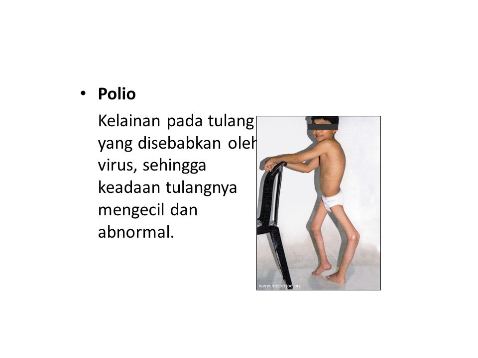 Polio Kelainan pada tulang yang disebabkan oleh virus, sehingga keadaan tulangnya mengecil dan abnormal.