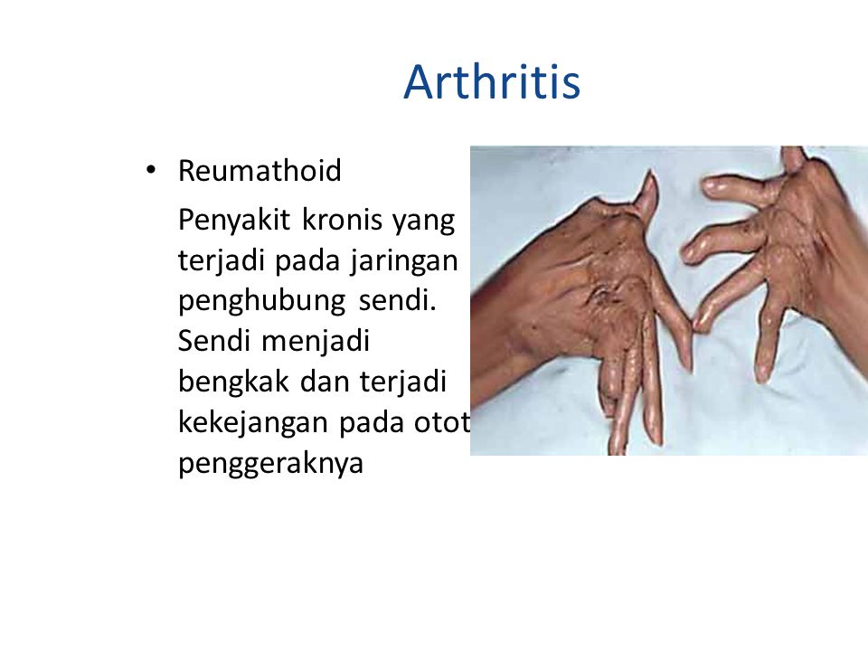 Arthritis Reumathoid.